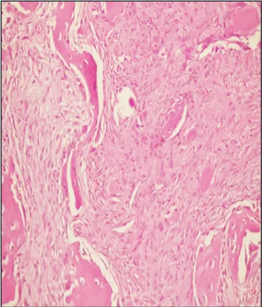 Figure 4A. Stromal fibroblasts producing bony matrix without  morphologic evidence of osteoblastic cells at the periphery of the 