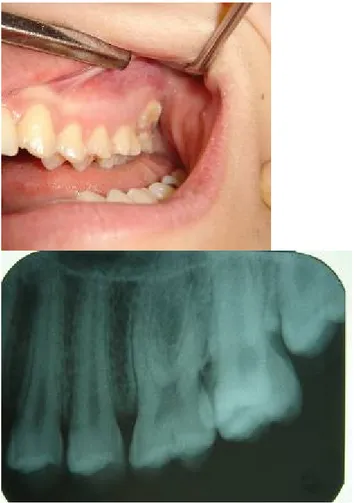Tablo 2. Sürnümerer molar dişlerin tek veya  iki  taraflı oluşu, 
