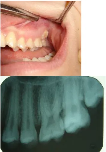 Tablo 2. Sürnümerer molar dişlerin tek veya  iki  taraflı oluşu, 