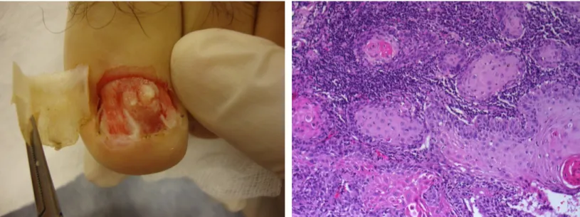 Figure 2. Macroscopic view of subungual  squamous cell carcinoma after nail avulsion  Figure 3