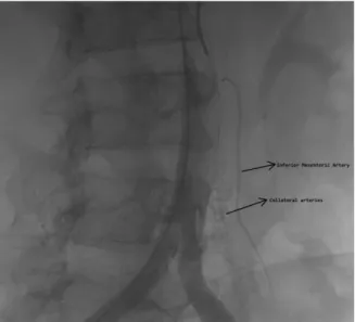 Figure 1.  Digital  substraction  angiography  showing  inferior  mesenteric artery and collaterals