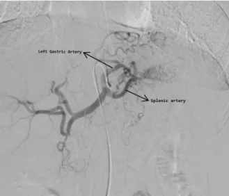 Figure 3.  Digital  substraction  angiography  showing  splenic,  left gastric arteries and collaterals