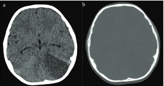 Fig 1. Non-contrast CT shows hypodens area with mass effect due to edema in the left cerebellar hemisphere (a)