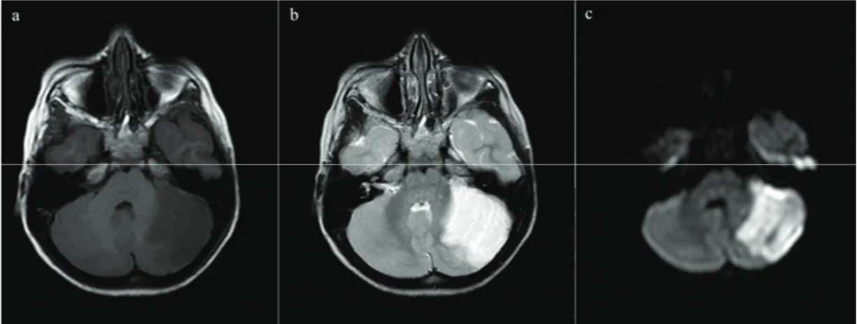Fig 2. MRI and DWI show an infarction at the superior cerebellar artery territory in the left cerebellar hemisphere