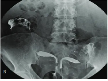 Figure 1. Hysterosalpingography (HSG) revealing uterus didelphys and very  long right tuba uterina lying under the liver