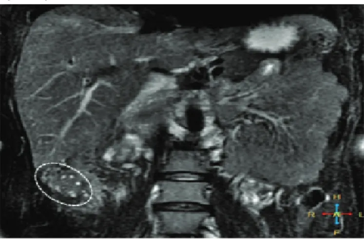 Figure  2.  Magnetic  resonance  imaging  (MRI)  revealing  unusually  localized  right ovary