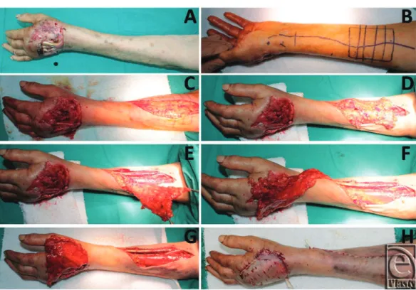 Figure 1. (a) The defect of the dorsum of the hand in a 67 years old woman. (b) Flap dimensions are designed according to the size of the defect