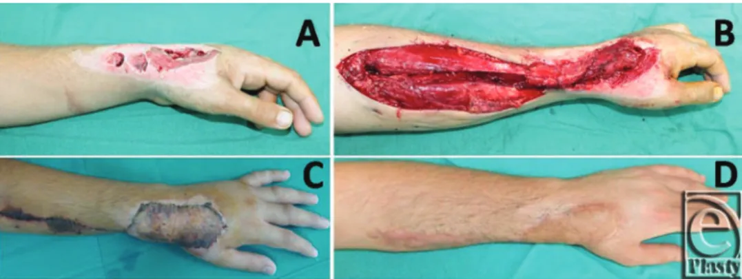 Figure 5. (a) Dorsal hand defect. (b) Flap transposition. (c) Early postoperative result