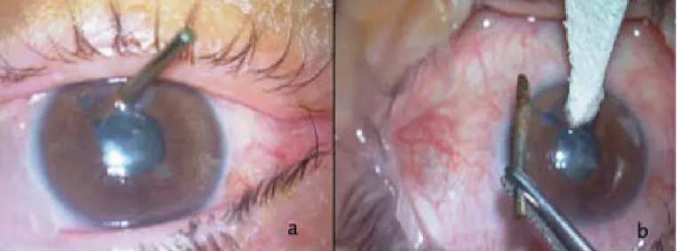 Figure 1: Photographies from operating microscope. a : Preoperatively b: Just after removing of hair clip.