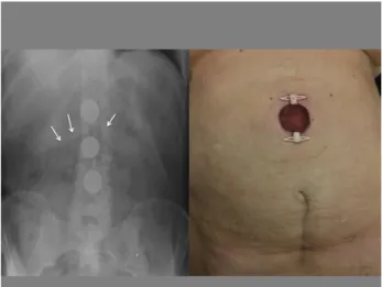 Figure  2. Plain  abdominal  graph  shows  the  shadows  of  the  coins,  and  gas  in  the  transvers  colon  (white  arrows)  (on the left)