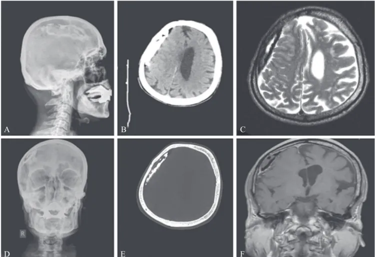 figure 3.—case 2. Plain film radiograph showed calcification at the right frontoparietal region (A, B)