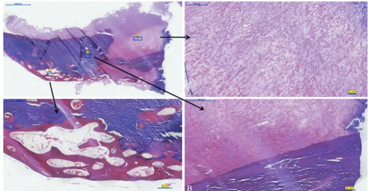 Figure 4.—Case 2. Perioperative view of ossified IDH. The ossified mass was lodged between the inner and outer layers of the dura (A, B)