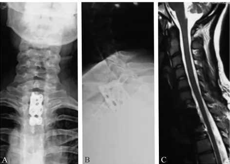 figure 3.—Postoperative radiological studies: a, B) postoperative X-ray; c) postoperative sagittal T2W Mri shows the titanium mesh implant and  anterior plate fixation.