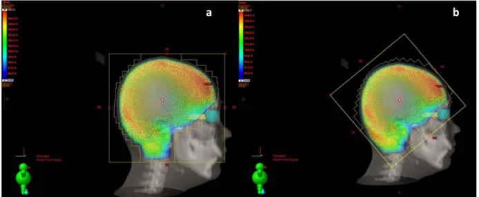 Figure	 2	 shows	 the	 DVH	 comparison	 of	 a													 patient.	 For	 the	 entire	 OAR,	 CT	 allowed	 us	 to							 obtain	lower	doses	at	OAR 