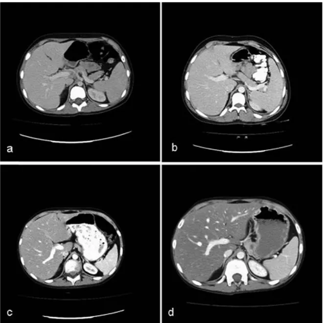 Fig.  1(a-d.) Hepatosteatosis grades of patients, as shown by computed tomography