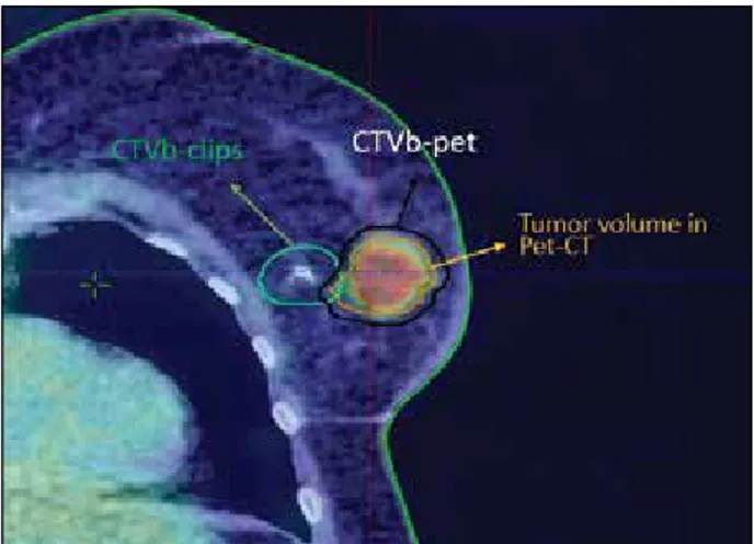 Fig. 1.  Deformable fusion image obtained by superpos- superpos-ing pre-op PET-CT and plannsuperpos-ing CT images  us-ing TPS.