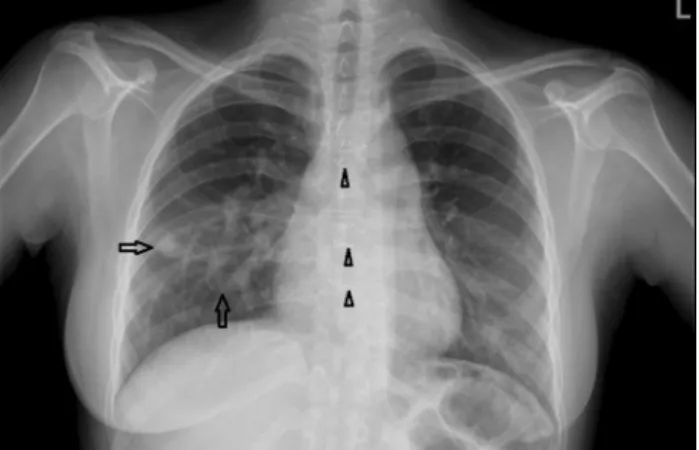 Fig.  1  Posteroanterior chest X-ray shows two dilated and  curved tubular structures (arrows) coursing and converging  toward the right pulmonary hilus, anomalously