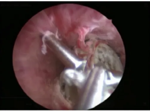 Fig. 3. Shape and size of the foreign body removed from the urethra.