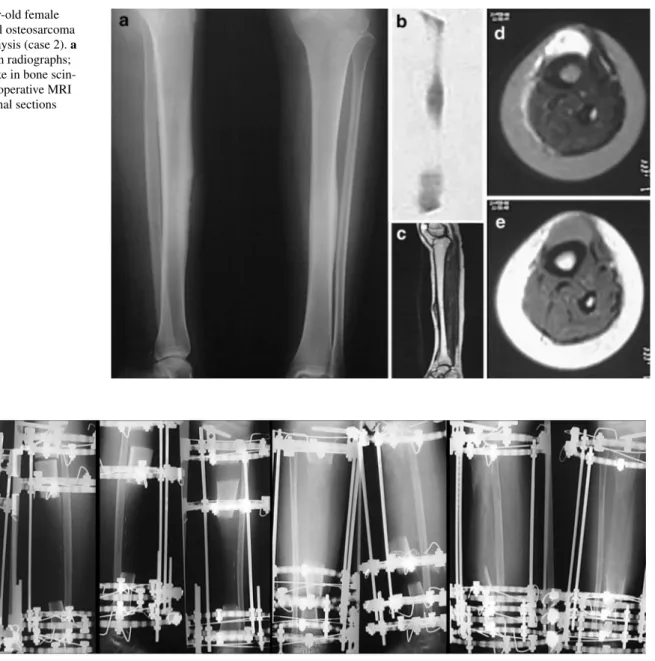 Fig. 1   A 15-year-old female  with conventional osteosarcoma  in the tibial diaphysis (case 2)