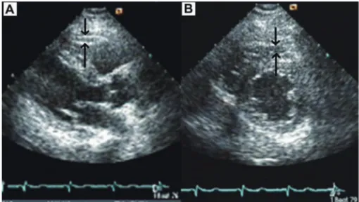 Fig. 1.  Measurement of epicardial fat thickness by two-dimentional transthoracic echocardiography.