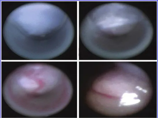 FIG. 2. (A, B) The all-seeing nee- nee-dle on the left and the Veress neenee-dle on the right.