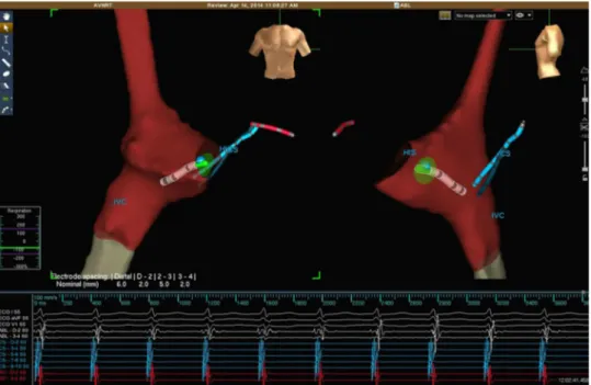 Fig. 1 Electroanatomical right atrial geometry showing catheters including coronary sinus catheter (blue tube) and right ventricular catheter (red tube) as well as cryoablation catheter (green tube)