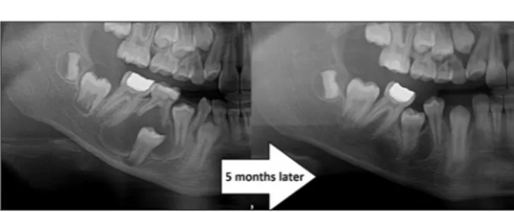 Figure 4: Resolution of the cystic lesion and eruption of the impacted  tooth after marsupialization