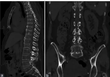 Figure 1: Thoracoabdominal CT examination with sagittal (a) and  coronal (b) images reveal numerous high‑density droplets within the thoracic and 