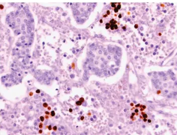 Figure 2 Unless software modification is carried out on indivi- indivi-dual cells, the Automated Cellular Imaging System (ACIS s ) cannot distinguish tumoral from non-tumoral cells