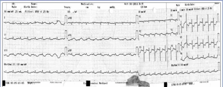 Figure 1. Electrocardiogram obtained immediately after defibrillation showing ST elevation in DI and aVL leads, and ST depres- depres-sion in inferior and V3–6 leads.