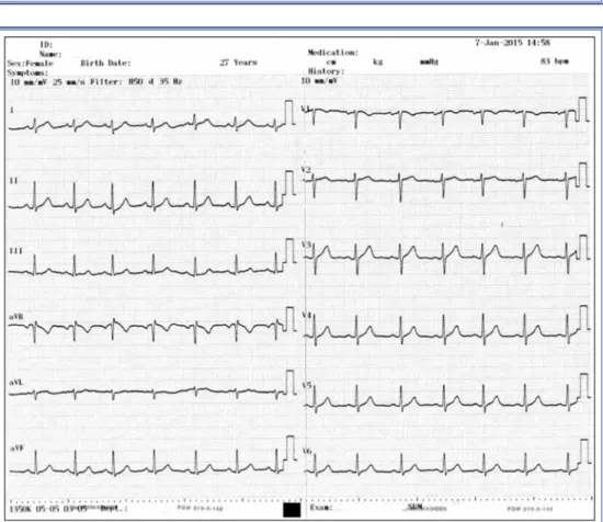 Figure 4. Electrocardiogram obtained 1 month after discharge showing normal sinus rhythm and  no ST-T segment alteration.