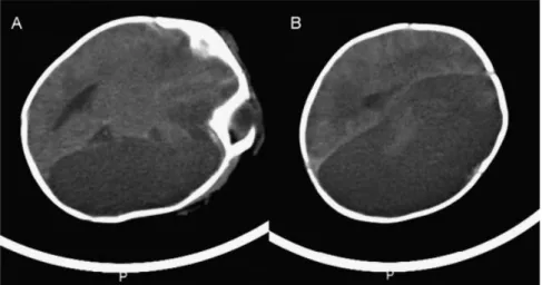 Fig. 2 (A, B) Axial diffusion-weighted image demonstrating diffusion limitations congruent with acute infarct in the territory of left cerebral artery, left basal ganglia, and focal areas of right parietal lobe.