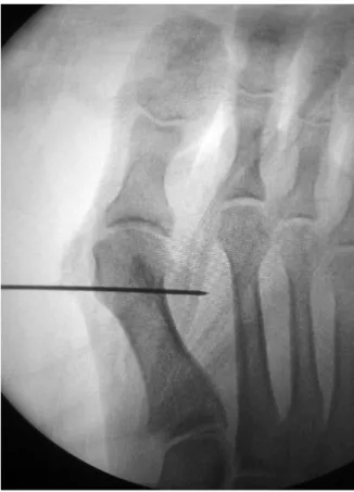 Fig. 2. Anteroposterior ﬂuoroscopic image showing transient ﬁxation of the Kirschner wire after lateralization and plantarization of the distal fragment after distal oblique metatarsal osteotomy.