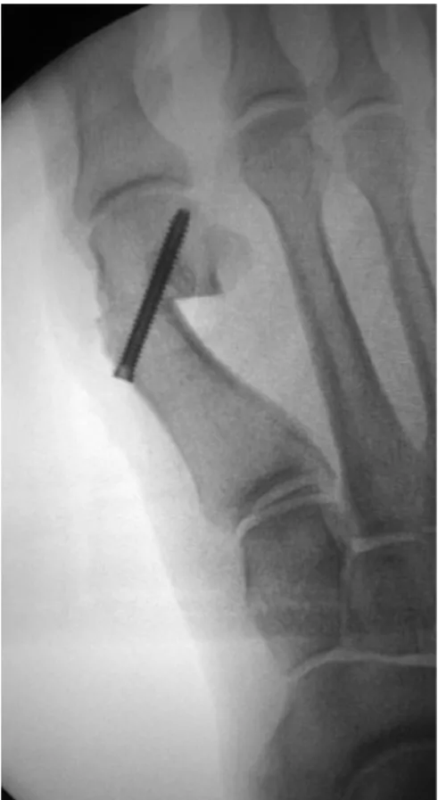 Fig. 4. Anteroposterior radiograph of 37-year-old female patient’s foot while standing at postoperative day 15.