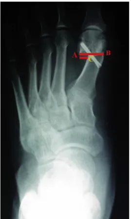 Fig. 8. Measurement of the lateral displacement of the distal ﬁrst metatarsal. It was calculated as the ratio of the distance between the lateral sides of the distal and proximal metatarsals (point A to point C) to the distal mediolateral length of the pro