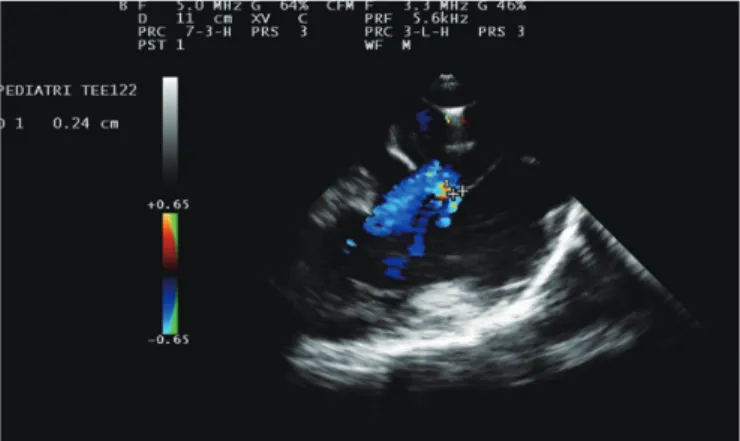 Fig. 2. Aneurysmatic septum and three defects at bicaval position on  transesophageal echocardiography in a 10-year-old female patient  performed balloon septoplasty