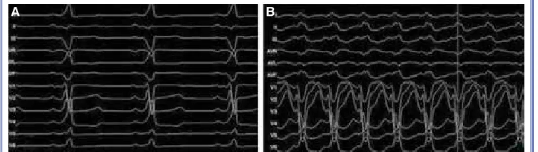 Figure 1. (A) Twelve-lead electrocardiography showing pre-excited QRS morphology with  short PR interval