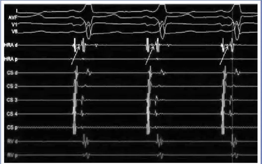 Figure 3. Mahaim potentials (arrow) observed at the lateral tricuspid annulus.