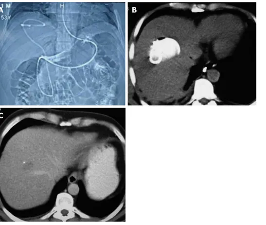 Figure 2  Nasocystic-biliary drainage procedure. A: Topographic images of hydatid cyst with major rupture by nasocystic drainage; B: Drainage catheter within the  cystic cavity; C: Computed tomography of the same patient taken at the three-month follow-up.