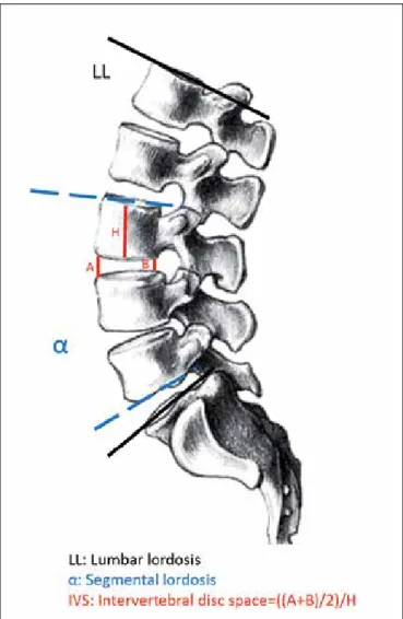 Figure 1:  Lumbar  segmental  lordosis,  lumbar  lordosis  and  intervertebral disc space were used as radiological measurements