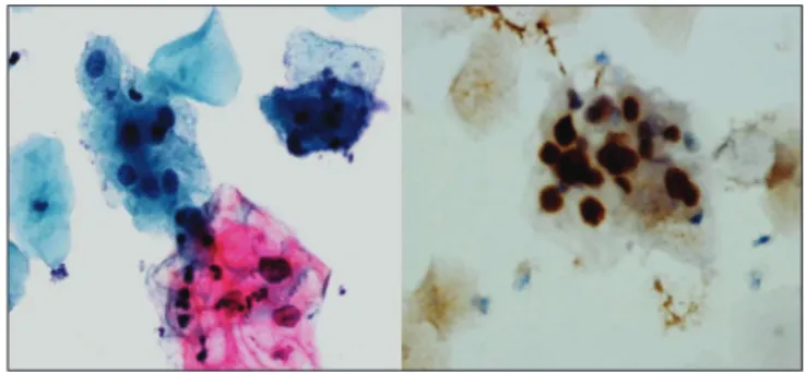 Figure 3: ProEx C immunoreactivity in lower one‑third of cervical epithelium 