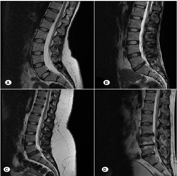 Figure 2: Sagittal section  of T2 weighted MRI  showed Schneiderman disc  degeneration classification  of patients