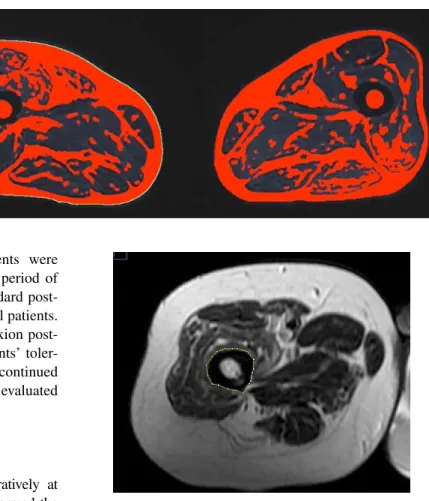 Fig. 1   Calculation of the total  volume of the right thigh on  single axial T2-weighted MRI