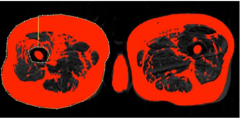 Fig. 3   Calculation of right  thigh soft tissue (fat and  con-nective tissue) volume on single  axial T2-weighted MRI