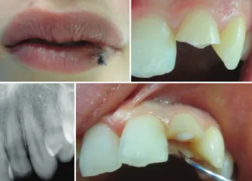 Figure 2: Postoperative images (a) immediately after reattachment  showing color difference because of dehydration (b) harmonious 