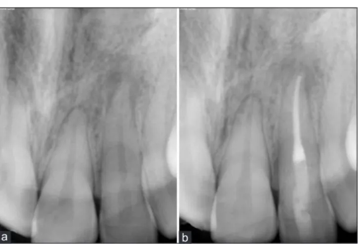 Figure 5: Preoperative images of a fractured maxillary right 