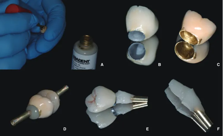 Fig. 1.  (A) Application of die spacer into intaglio surface of crown restoration, (B) The crown restoration before and (C)  after die spacer application, (D) Crown restoration was filled with a small amount of bis-acrylic temporary restorative  material, 