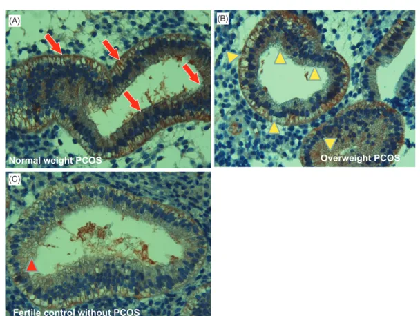 Figure 3. The scatter plot between H-Score of NF jB/65 (RelA) expression and body mass index in overweight PCOS group.