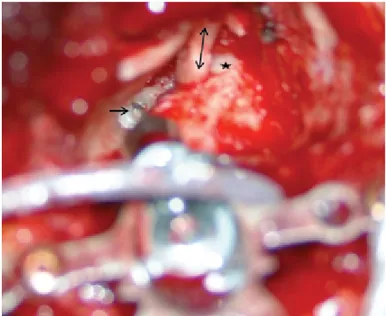 Figure 1. Intraoperative view of Carina that was fitted to the endosteum, →: Ca- Ca-rina fitted to the cochlear endosteum;  ↔: tragal cartilage that was used to  recon-struct the outer ear canal; *: lateral semicircular canal