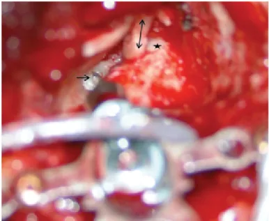 Figure 1. Intraoperative view of Carina that was fitted to the endosteum, →: Ca- Ca-rina fitted to the cochlear endosteum;  ↔: tragal cartilage that was used to  recon-struct the outer ear canal; *: lateral semicircular canal